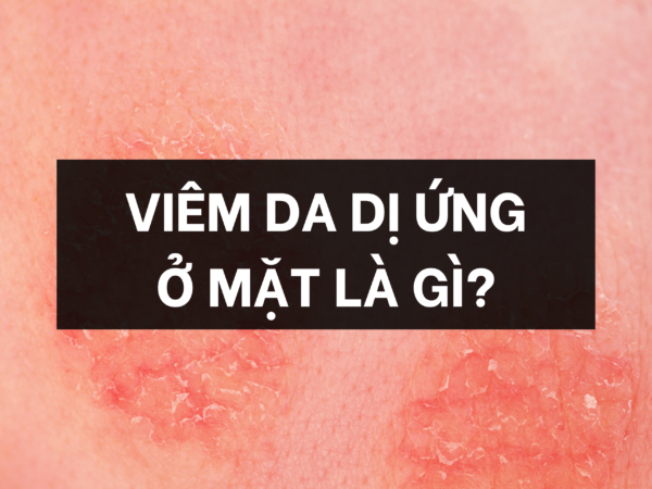 Viêm da dị ứng ở mặt là gì?