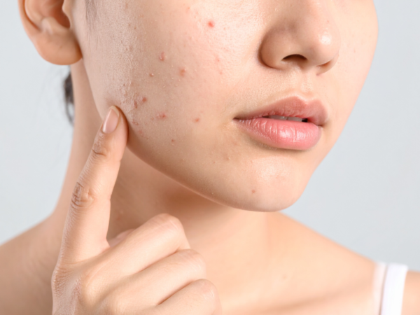 Nồng độ phù hợp cho tình trạng mụn